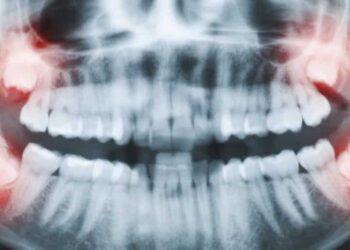 Wisdom Teeth Impacted