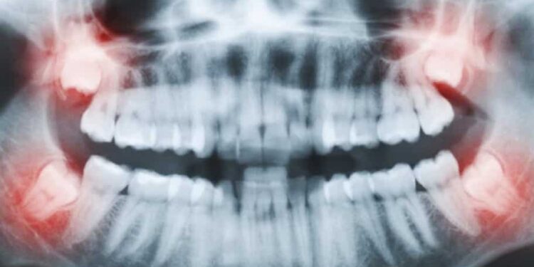 Wisdom Teeth Impacted