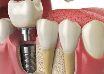 dental-implants