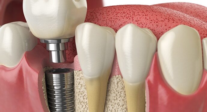 dental-implants
